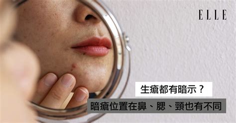 人中位置生暗瘡|【暗瘡位置】不同代表什麼？中醫教如何處理及預防